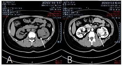 Case report: Solitary fibrous tumor of the kidney with a NAB2-STAT6 fusion gene